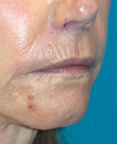 Lip Lift Before and After | Princeton Plastic Surgeons