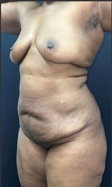 Liposuction New Jersey