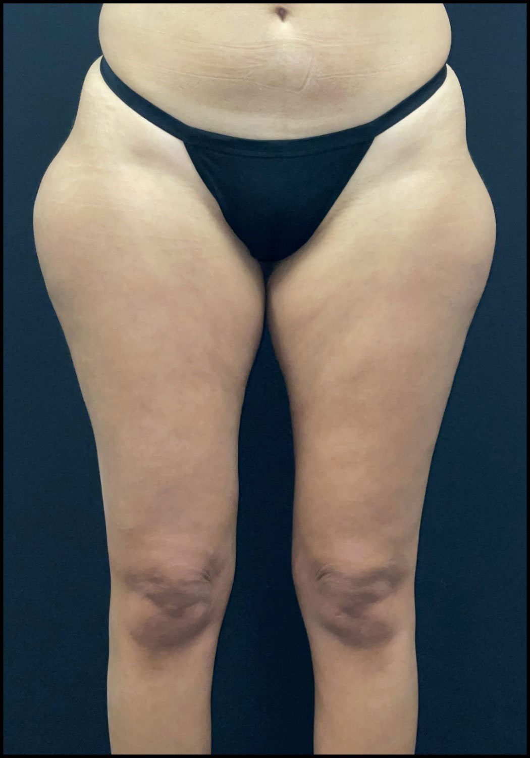 Liposuction Before and After | Princeton Plastic Surgeons