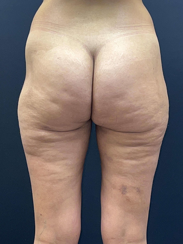 Liposuction Before and After | Princeton Plastic Surgeons