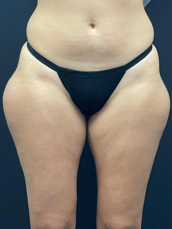 Liposuction Before and After | Princeton Plastic Surgeons