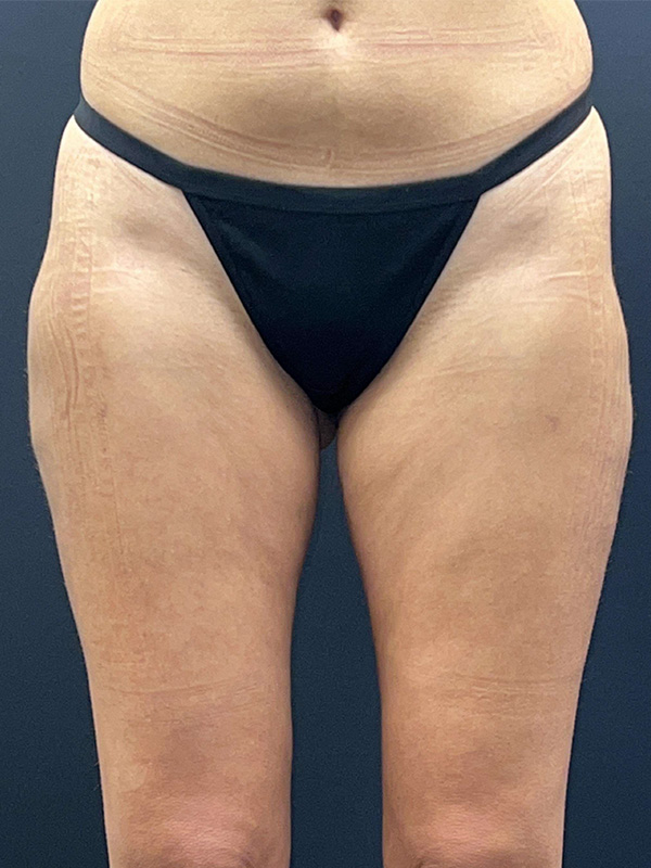 Liposuction Before and After | Princeton Plastic Surgeons