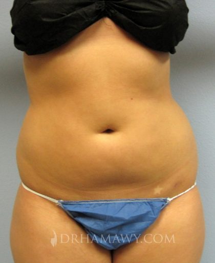 Liposuction Before and After | Princeton Plastic Surgeons