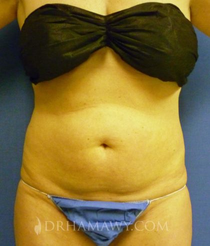 Liposuction Before and After | Princeton Plastic Surgeons