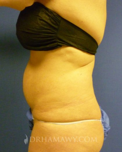 Liposuction Before and After | Princeton Plastic Surgeons