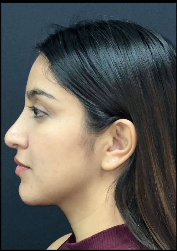 Liquid Rhinoplasty Before and After | Princeton Plastic Surgeons