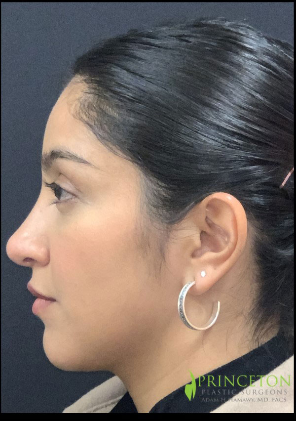 Liquid Rhinoplasty Before and After | Princeton Plastic Surgeons