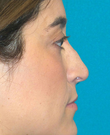 Liquid Rhinoplasty Before and After | Princeton Plastic Surgeons