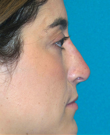 Liquid Rhinoplasty Before and After | Princeton Plastic Surgeons