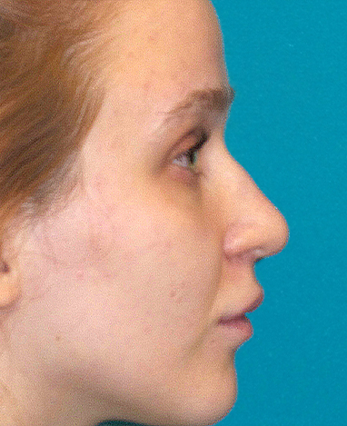 Liquid Rhinoplasty Before and After | Princeton Plastic Surgeons