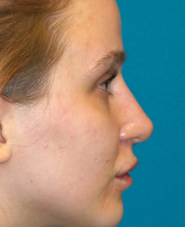 Liquid Rhinoplasty Before and After | Princeton Plastic Surgeons