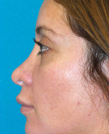 Liquid Rhinoplasty Before and After | Princeton Plastic Surgeons