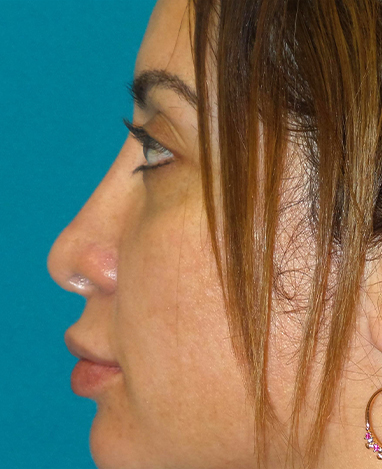 Liquid Rhinoplasty Before and After | Princeton Plastic Surgeons