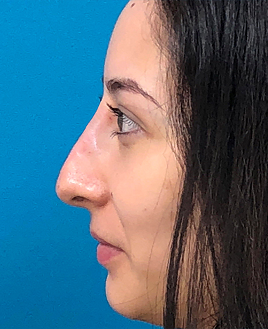 Liquid Rhinoplasty Before and After | Princeton Plastic Surgeons