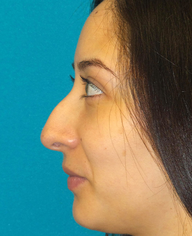 Liquid Rhinoplasty Before and After | Princeton Plastic Surgeons