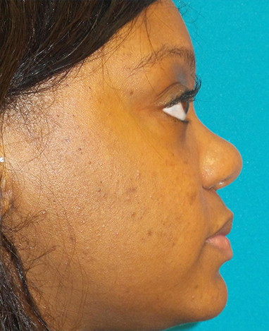 Liquid Rhinoplasty Before and After | Princeton Plastic Surgeons