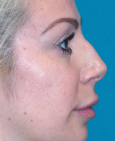 Liquid Rhinoplasty Before and After | Princeton Plastic Surgeons