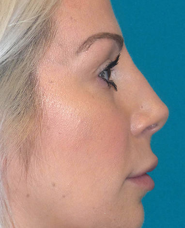 Liquid Rhinoplasty Before and After | Princeton Plastic Surgeons