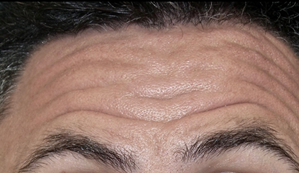 Male Botox Before and After | Princeton Plastic Surgeons