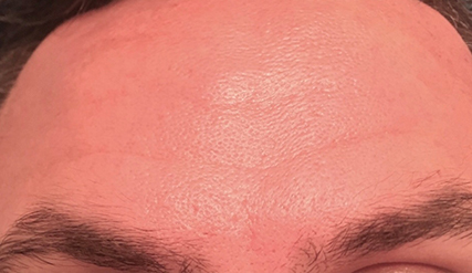 Male Botox Before and After | Princeton Plastic Surgeons