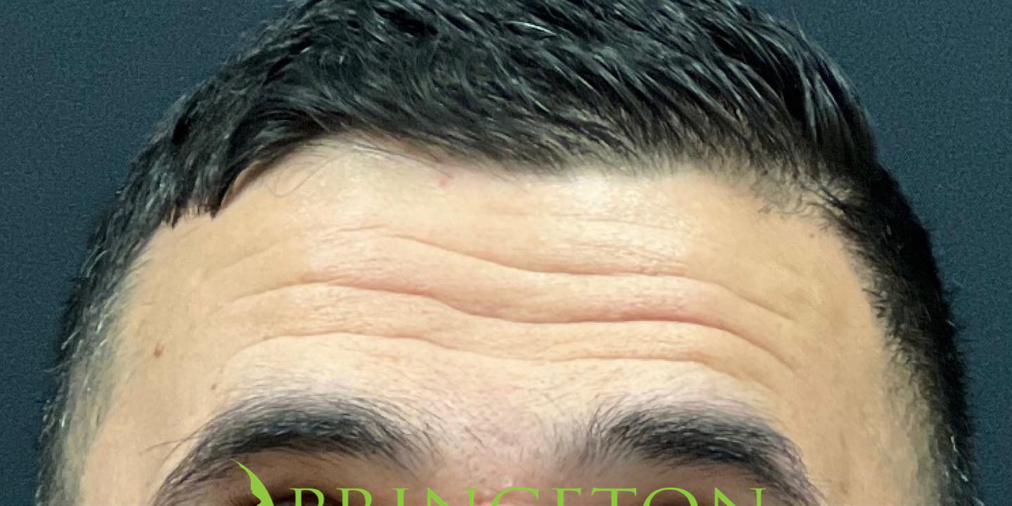 Male Botox Before and After | Princeton Plastic Surgeons