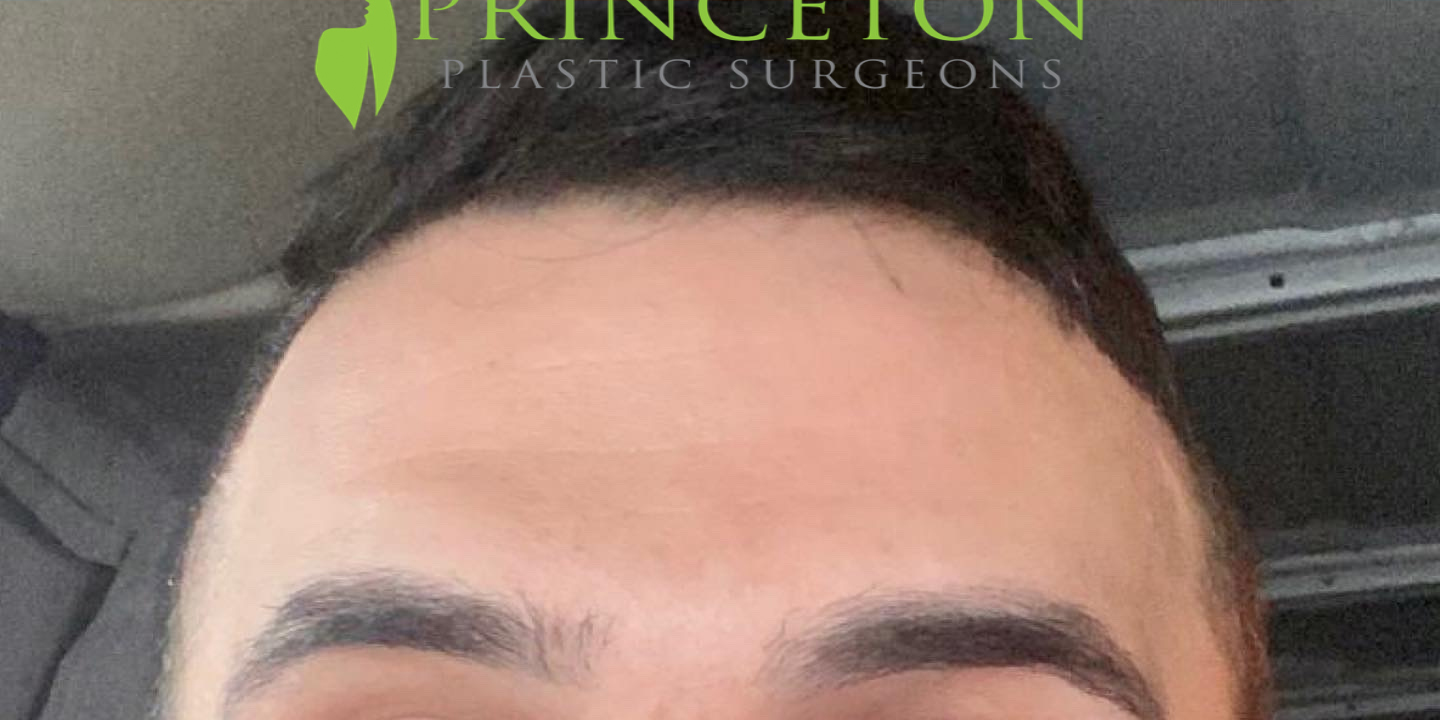 Male Botox Before and After | Princeton Plastic Surgeons