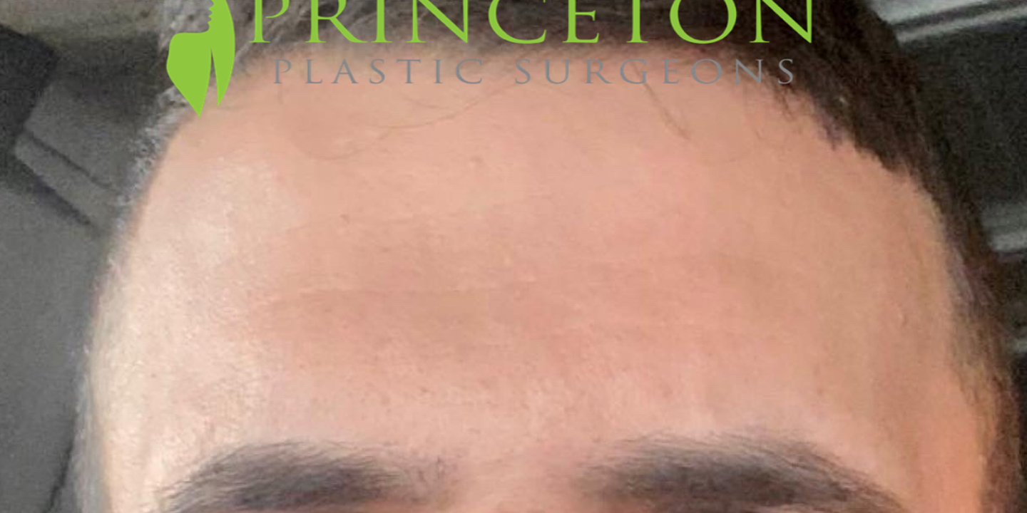 Male Botox Before and After | Princeton Plastic Surgeons