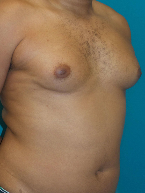 Male Chest Enhancement Before and After | Princeton Plastic Surgeons