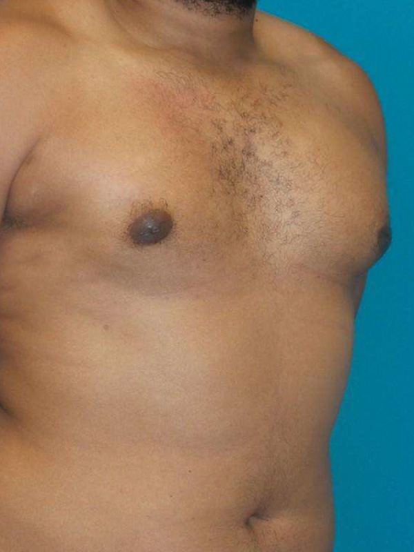 Male Chest Enhancement Before and After | Princeton Plastic Surgeons