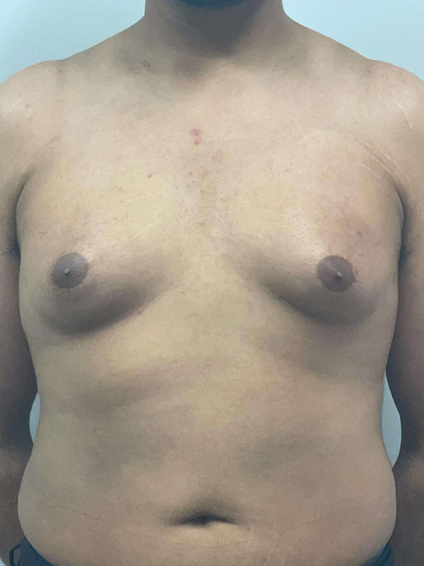 Male Chest Enhancement Before and After | Princeton Plastic Surgeons