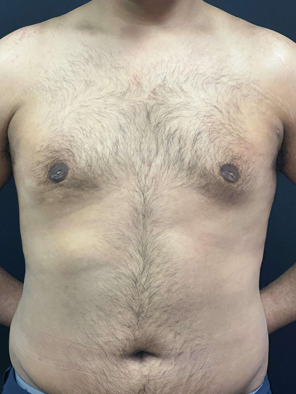 Male Chest Enhancement Before and After | Princeton Plastic Surgeons