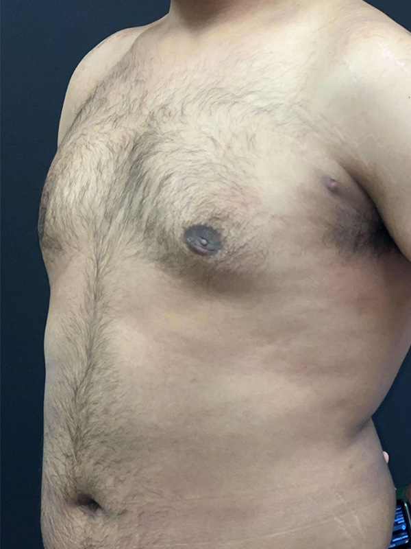 Male Chest Enhancement Before and After | Princeton Plastic Surgeons