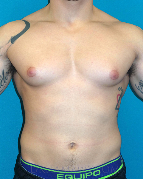 Male Chest Enhancement Before and After | Princeton Plastic Surgeons