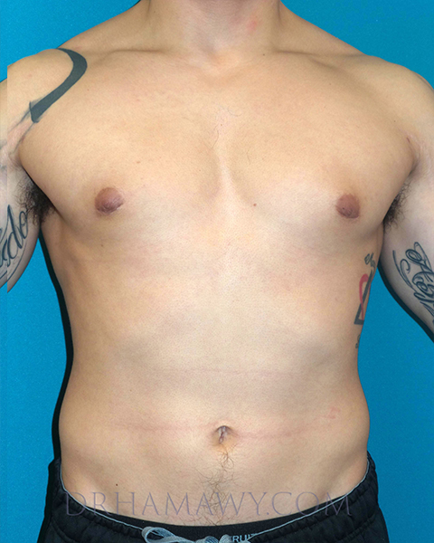 Male Chest Enhancement Before and After | Princeton Plastic Surgeons