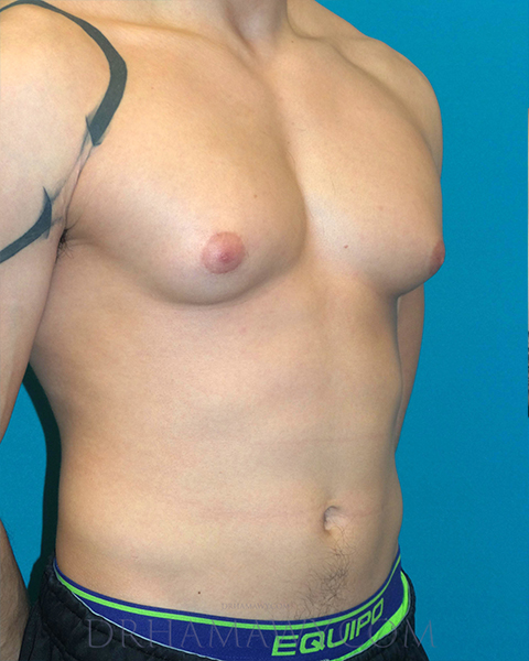 Male Chest Enhancement Before and After | Princeton Plastic Surgeons