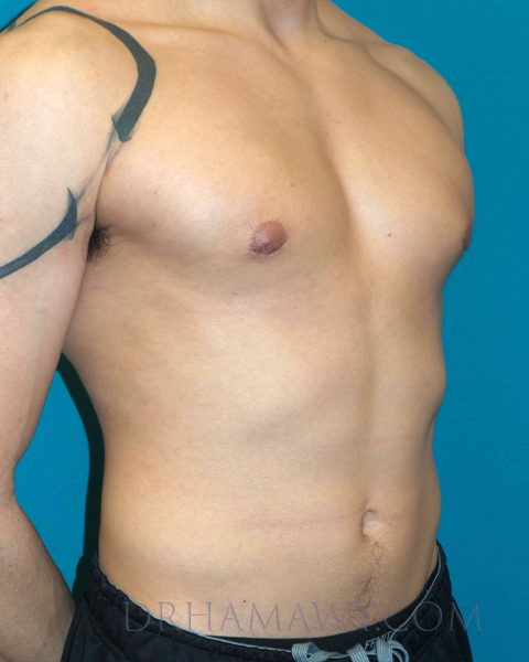 Male Chest Enhancement Before and After | Princeton Plastic Surgeons