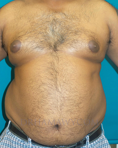 Male Chest Enhancement Before and After | Princeton Plastic Surgeons