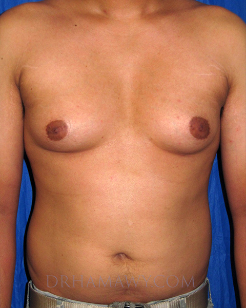 Male Chest Enhancement Before and After | Princeton Plastic Surgeons