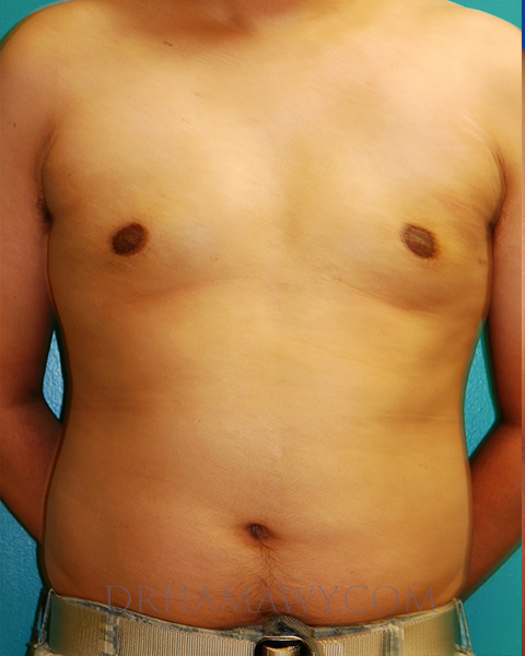 Male Chest Enhancement Before and After | Princeton Plastic Surgeons