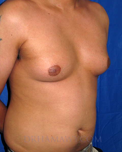 Male Chest Enhancement Before and After | Princeton Plastic Surgeons