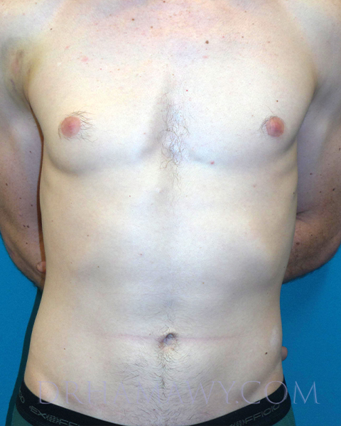 Male Chest Enhancement Before and After | Princeton Plastic Surgeons