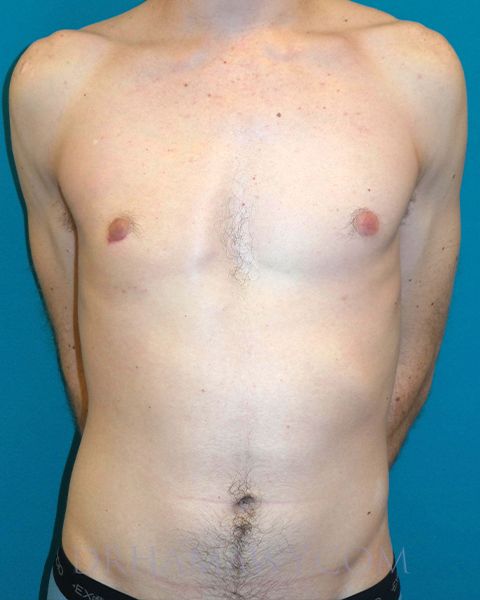 Male Chest Enhancement Before and After | Princeton Plastic Surgeons