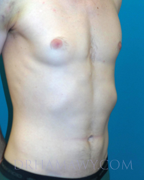 Male Chest Enhancement Before and After | Princeton Plastic Surgeons