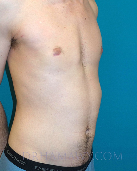 Male Chest Enhancement Before and After | Princeton Plastic Surgeons