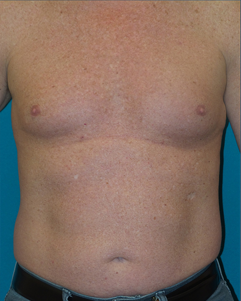 Male Chest Enhancement Before and After | Princeton Plastic Surgeons