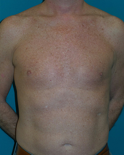 Male Chest Enhancement Before and After | Princeton Plastic Surgeons