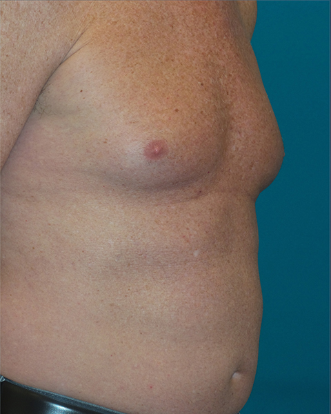 Male Chest Enhancement Before and After | Princeton Plastic Surgeons