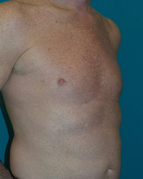 Male Chest Enhancement Before and After | Princeton Plastic Surgeons