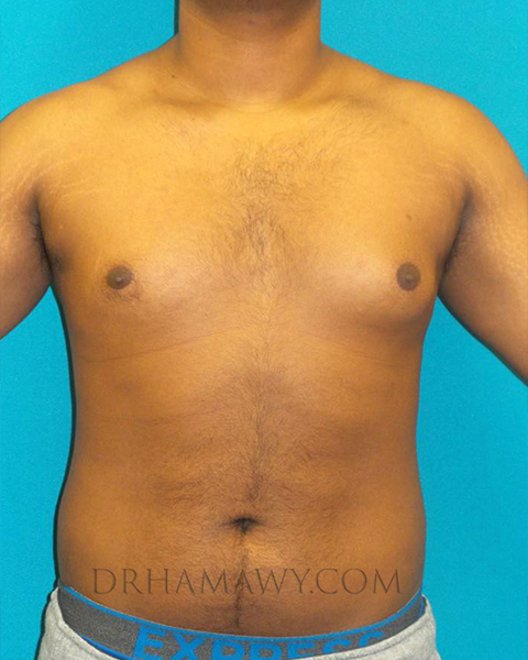 Male Chest Enhancement Before and After | Princeton Plastic Surgeons