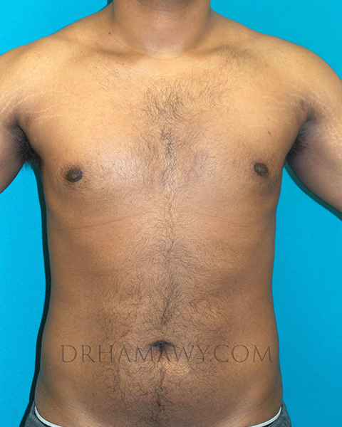 Male Chest Enhancement Before and After | Princeton Plastic Surgeons